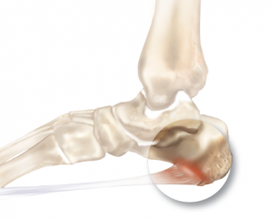 Inferior Calcaneal Spur