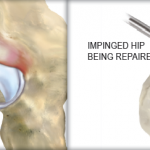 What is Hip Impingement?