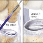 Postoperative Care After an ACL or Meniscus Repair