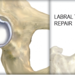 What is a Labral Tear?