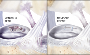Meniscus Tear