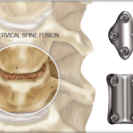 Spine Fusion