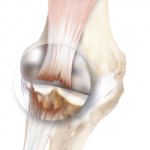 Biceps Tendon Tear or Rupture at the Elbow