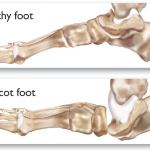 What is Charcot Foot?