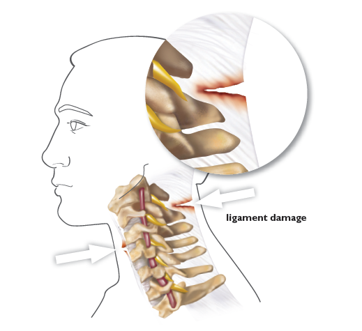 ligament damage